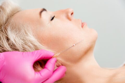 Thread Lift Treatment Applied To Jawline Area at Oceanshore Aesthetics and Wellness